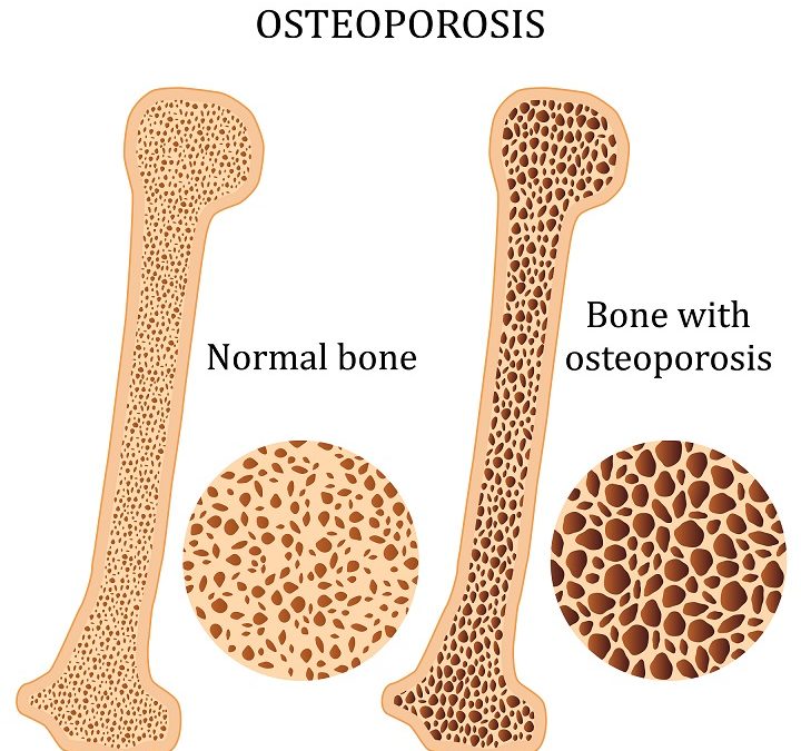 illustration of bone with osteoporosis