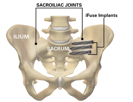 iFuse TORQ implant illustration in pelvis